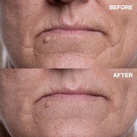 Mouth Wrinkle Patches